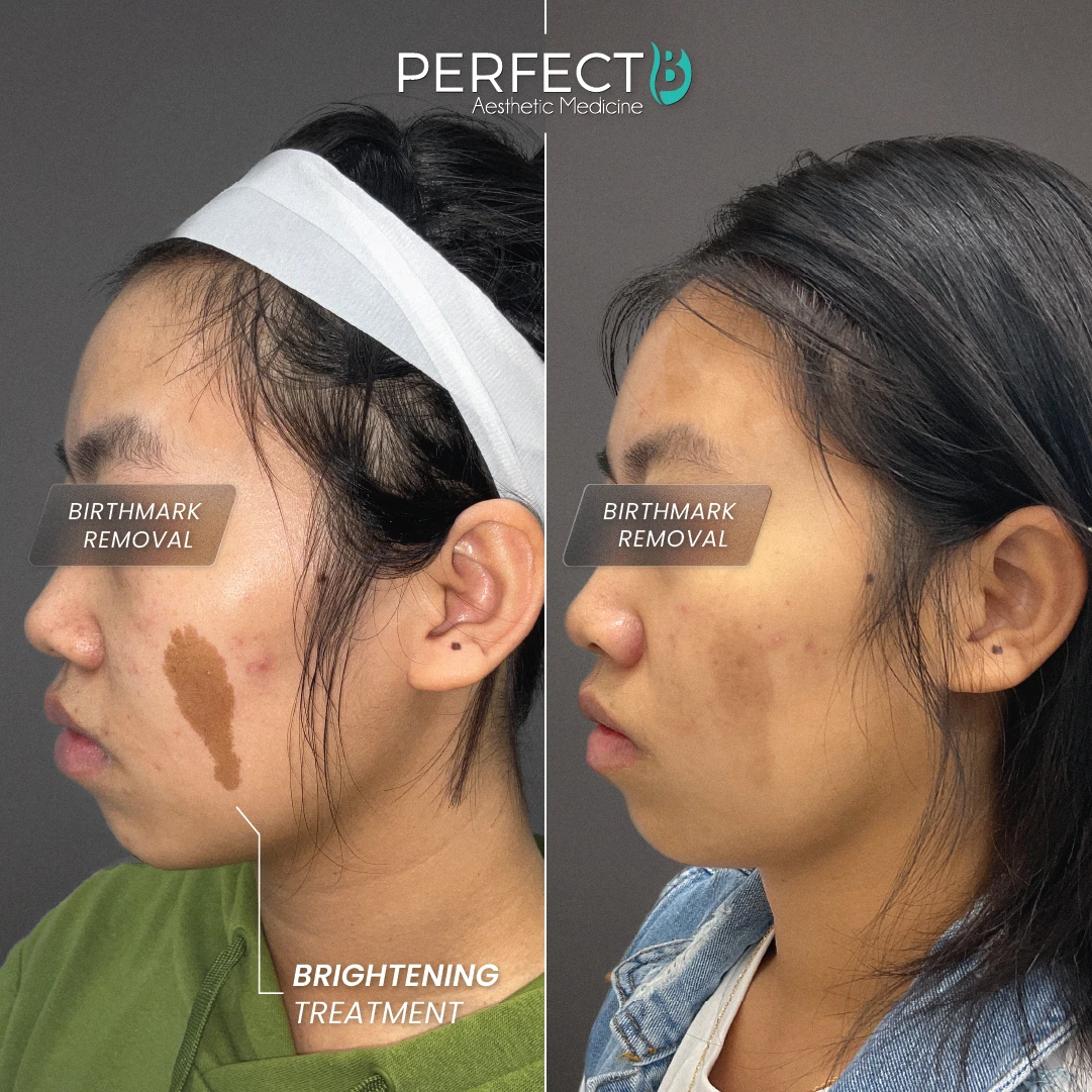 Brightening Treatment (Lesion Removal) - Perfect B - Results Image - Case 4503 - 1080 x 1080