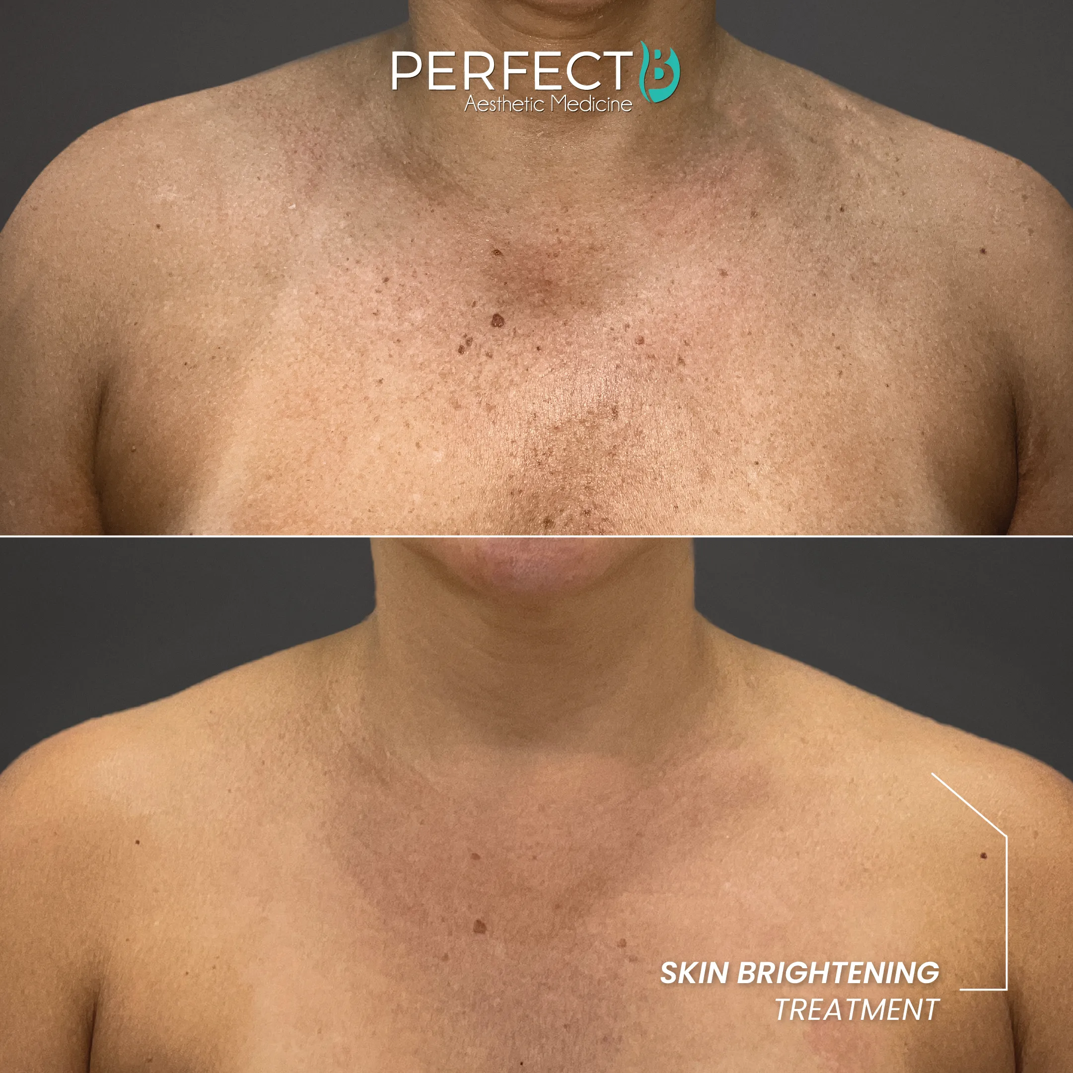 Brightening Treatment - Perfect B - Results Image - Case 4509 KM - 1080 x 1080