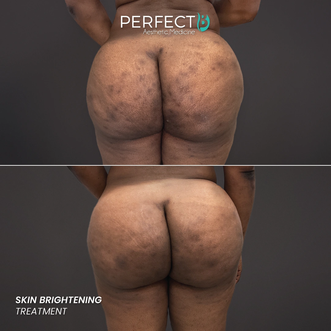 Brightening Treatment - Perfect B - Results Image - Case 4510 - 1080 x 1080