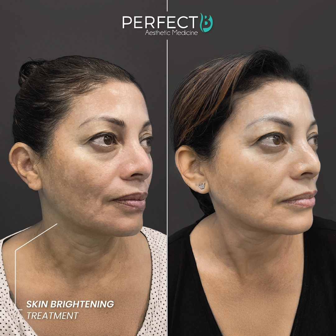 Brightening Treatment - Perfect B - Results Image - Case 4513 - 1080 x 1080