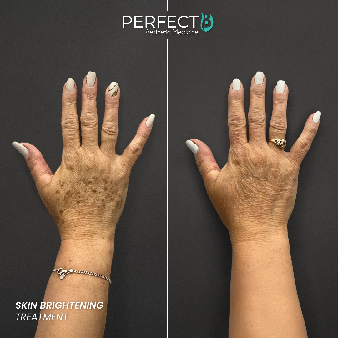 Brightening Treatment - Perfect B - Results Image - Case 4514 - 1080 x 1080