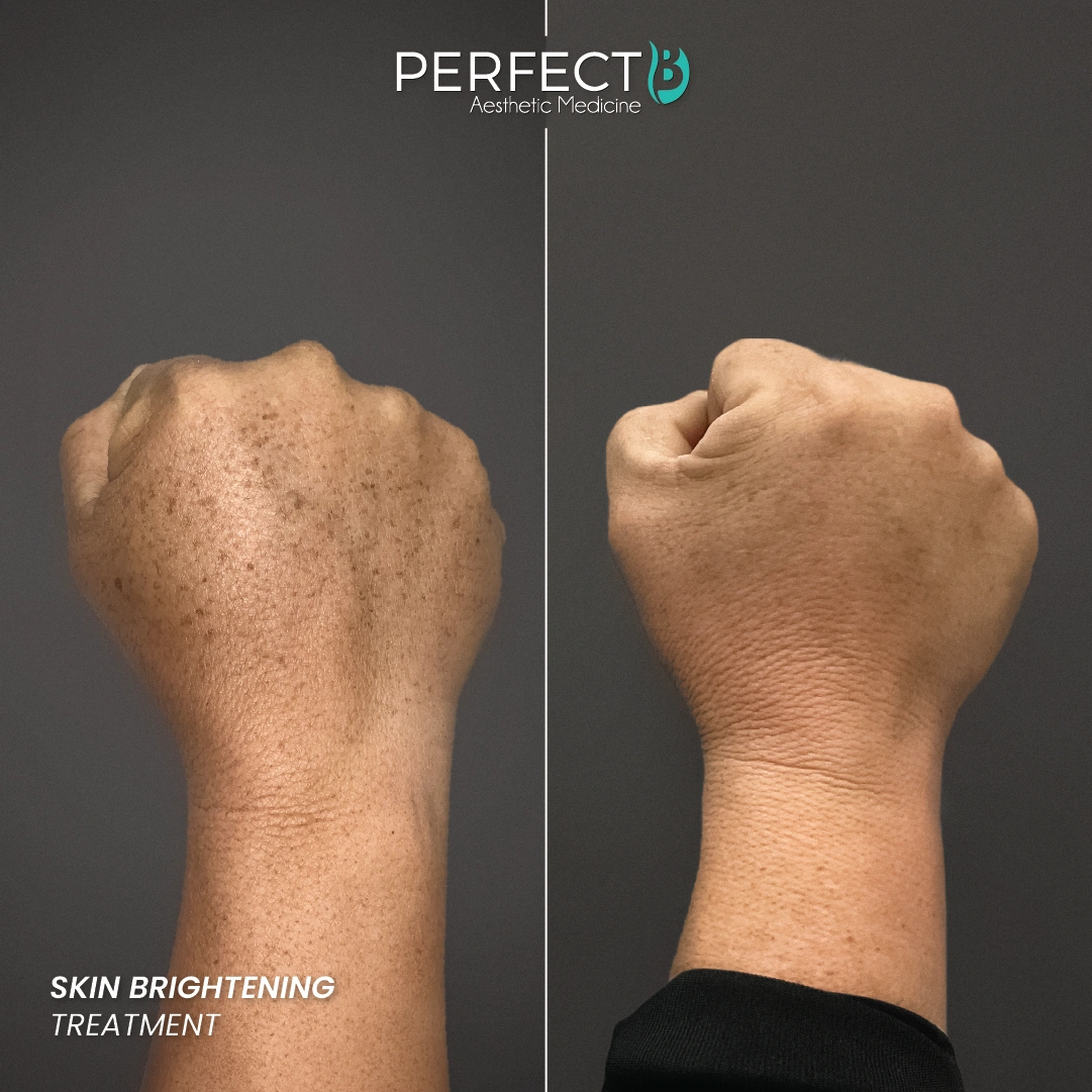 Brightening Treatment - Perfect B - Results Image - Case 4515 - 1080 x 1080