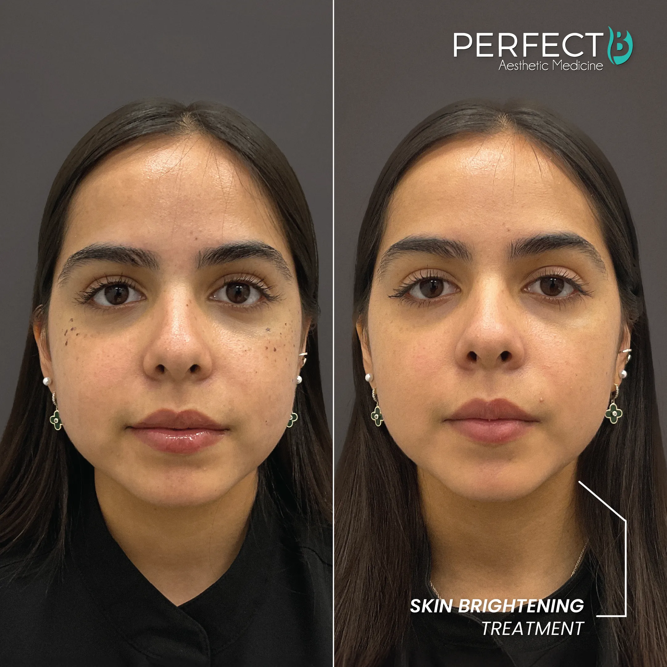 Brightening Treatment - Perfect B - Results Image - Case 4516 - 1080 x 1080