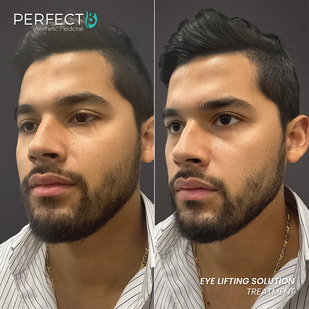 Eye Lifting Solution Treatment - Perfect B - Results Image - Case 5101 - 1080 x 1080