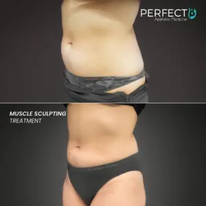 Muscle Sculpting Treatment - Perfect B - Results Image - Case 8023 - 1080 x 1080