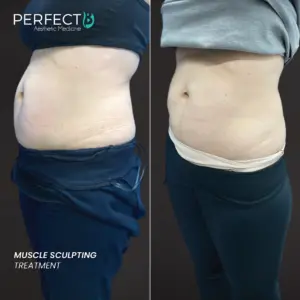 Muscle Scuplting Treatment - Perfect B - Results Image - Case 8212 - 1080 x 1080