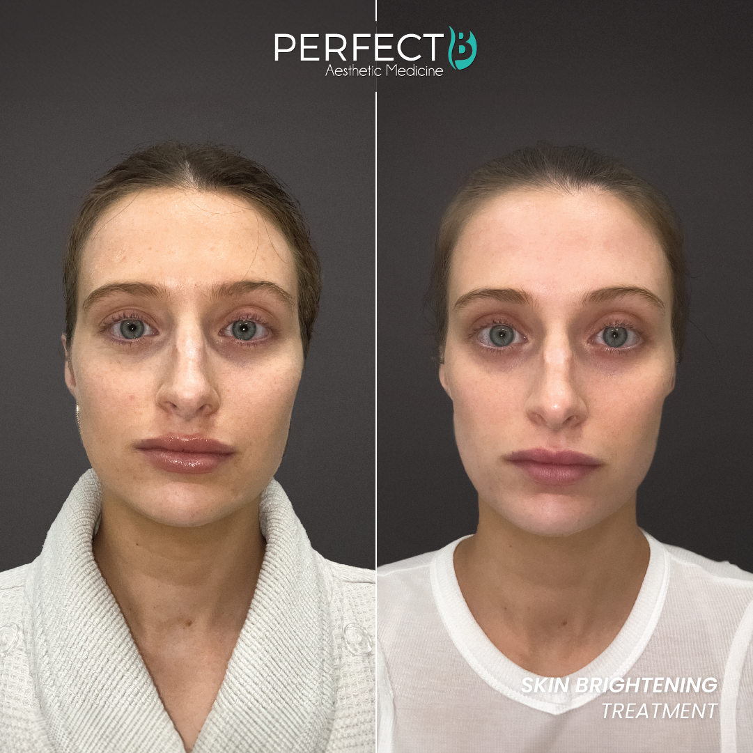 Skin Brightening Treatment - Perfect B - Results Image - Case 4502 - 1080 x 1080