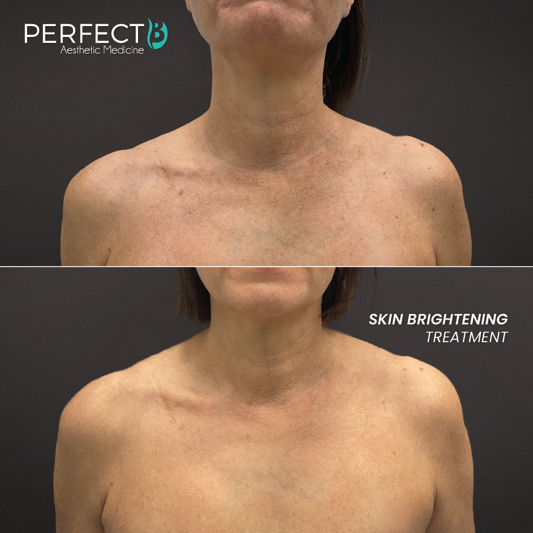 Skin Brightening Treatment - Perfect B - Results Image - Case 4506 - 1080 x 1080