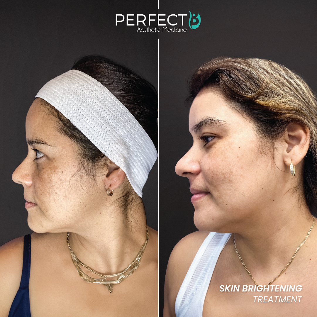 Skin Brightening Treatment - Perfect B - Results Image - Case 4507 - 1080 x 1080