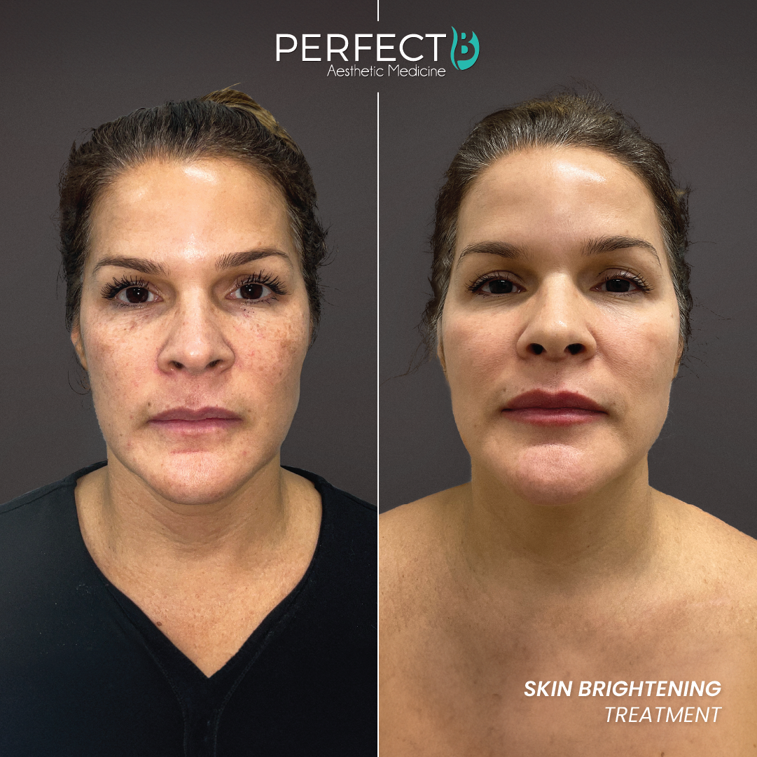 Skin Brightening Treatment - Perfect B - Results Image - Case 4509 - 1080 x 1080