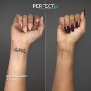 Tattoo Removal Treatment - Perfect B - Results Image - Case 9502- 1080 x 1080