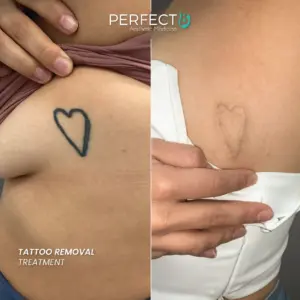 Tattoo Removal Treatment - Perfect B - Results Image - Case 9514 - 1080 x 1080