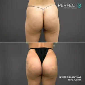 Glute Balancing Treatment - Perfect B - Results Image - Case 6201 - 1080 x 1080